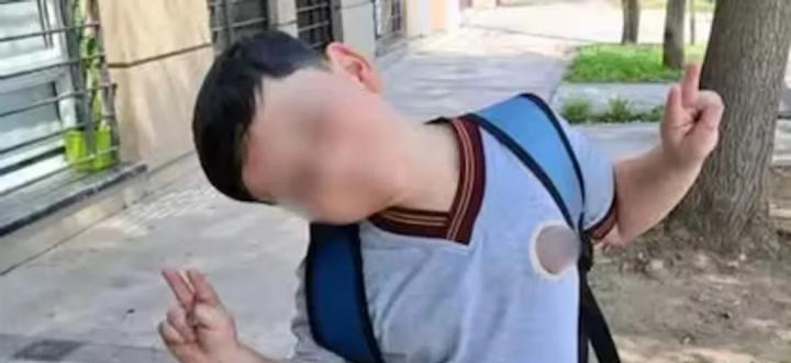 Bastián fue operado por sexta vez: traqueotomía y fijación cervical