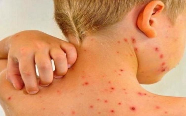 La OMS alerta por aumento en casos de sarampión