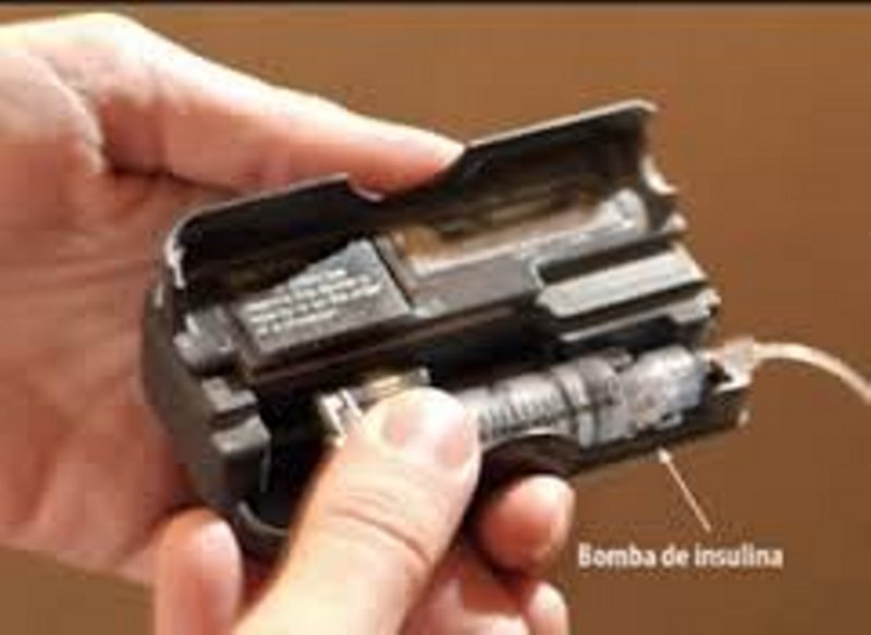 Perfeccionan el mecanismo para mejorar el suministro de bombas de insulina para diabéticos