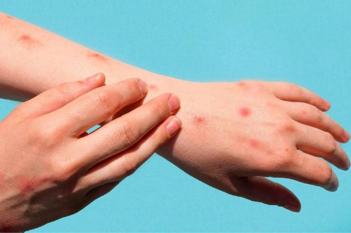 Primer caso de viruela símica en la ciudad de Santa Fe