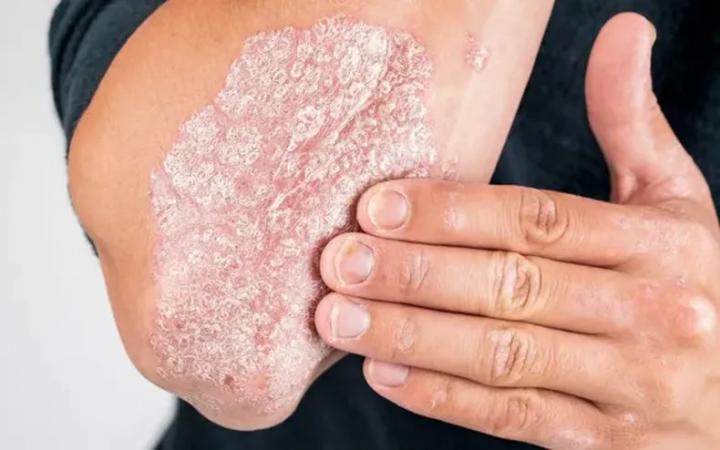 La ANMAT aprobó un nuevo medicamento para la psoriasis